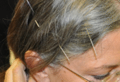 Acupuncture Treatment